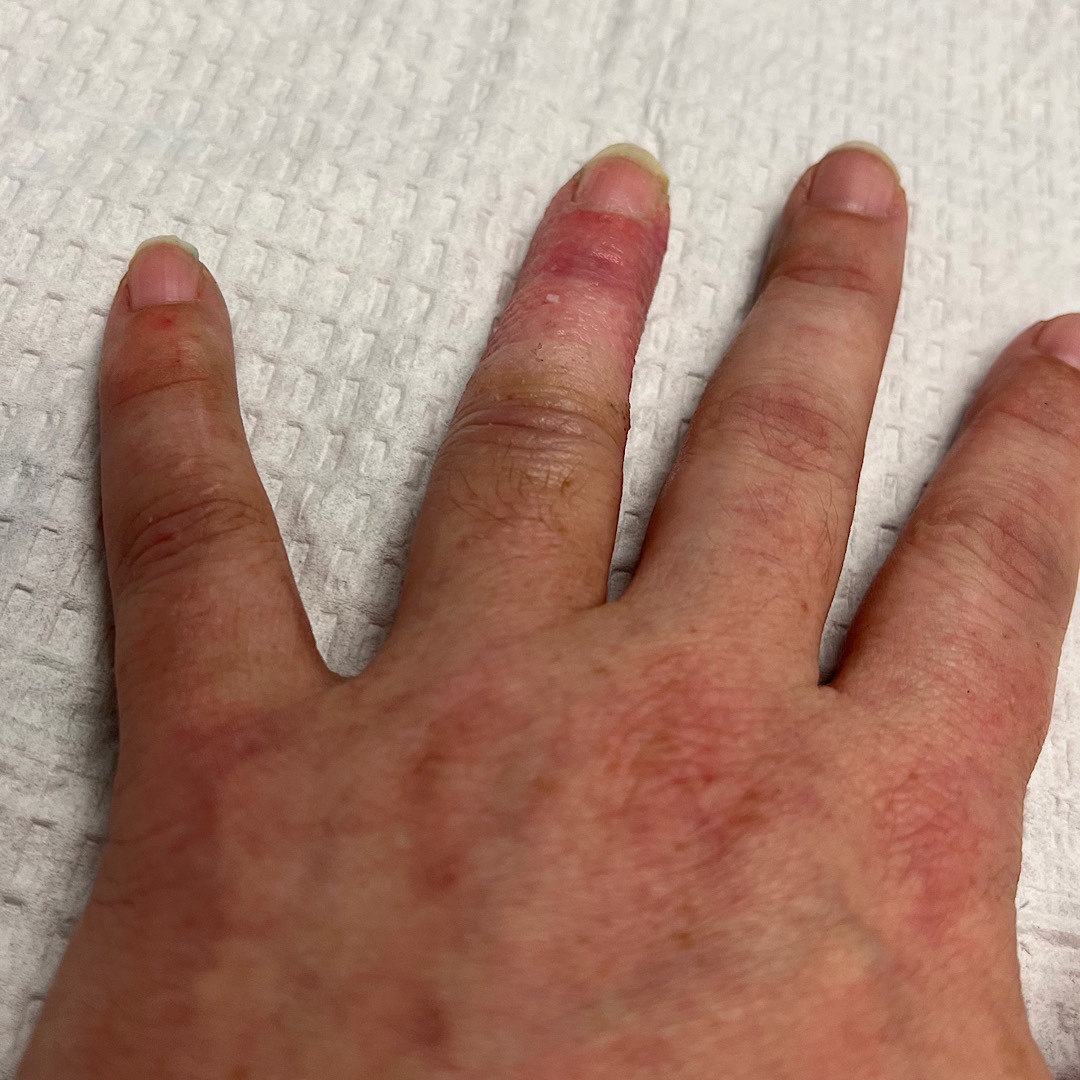 Cam Rising Finger Cast Free the Finger! Cast-free after 9 weeks | Angel Ackerman
